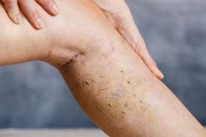 Venous Ablation | Endovenous Ablation Medical Malpractice