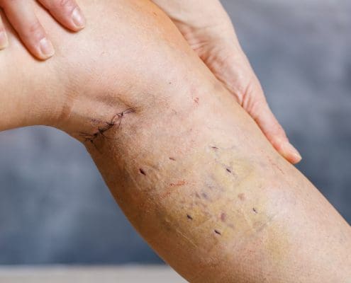 Venous Ablation | Endovenous Ablation Medical Malpractice