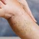 Venous Ablation | Endovenous Ablation Medical Malpractice