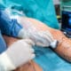 The Dangers of Botched Venous Surgery